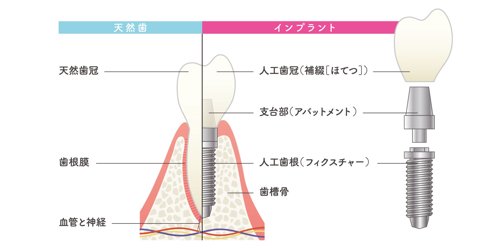 インプラント治療