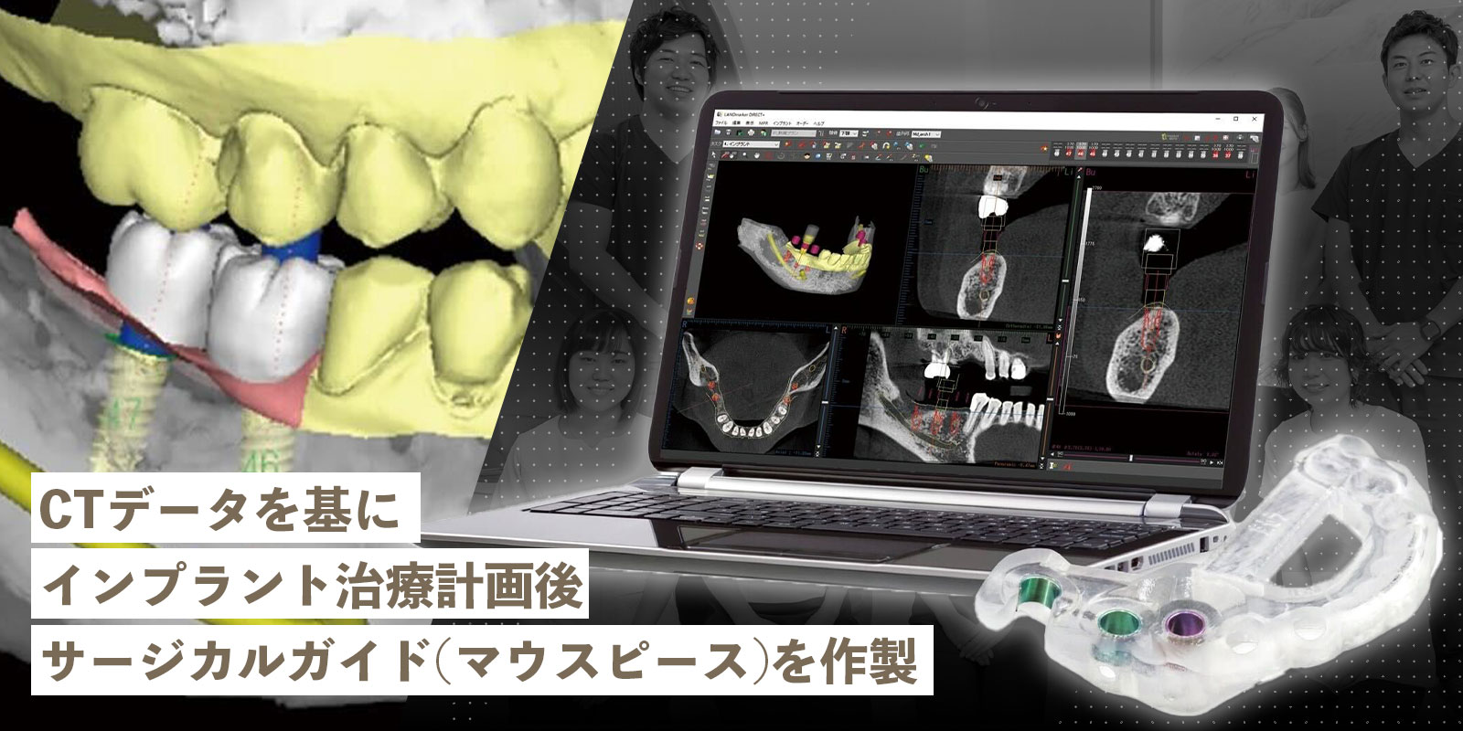 インプラント治療