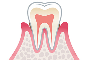軽度歯周炎、歯肉炎