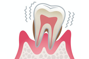重度歯周炎